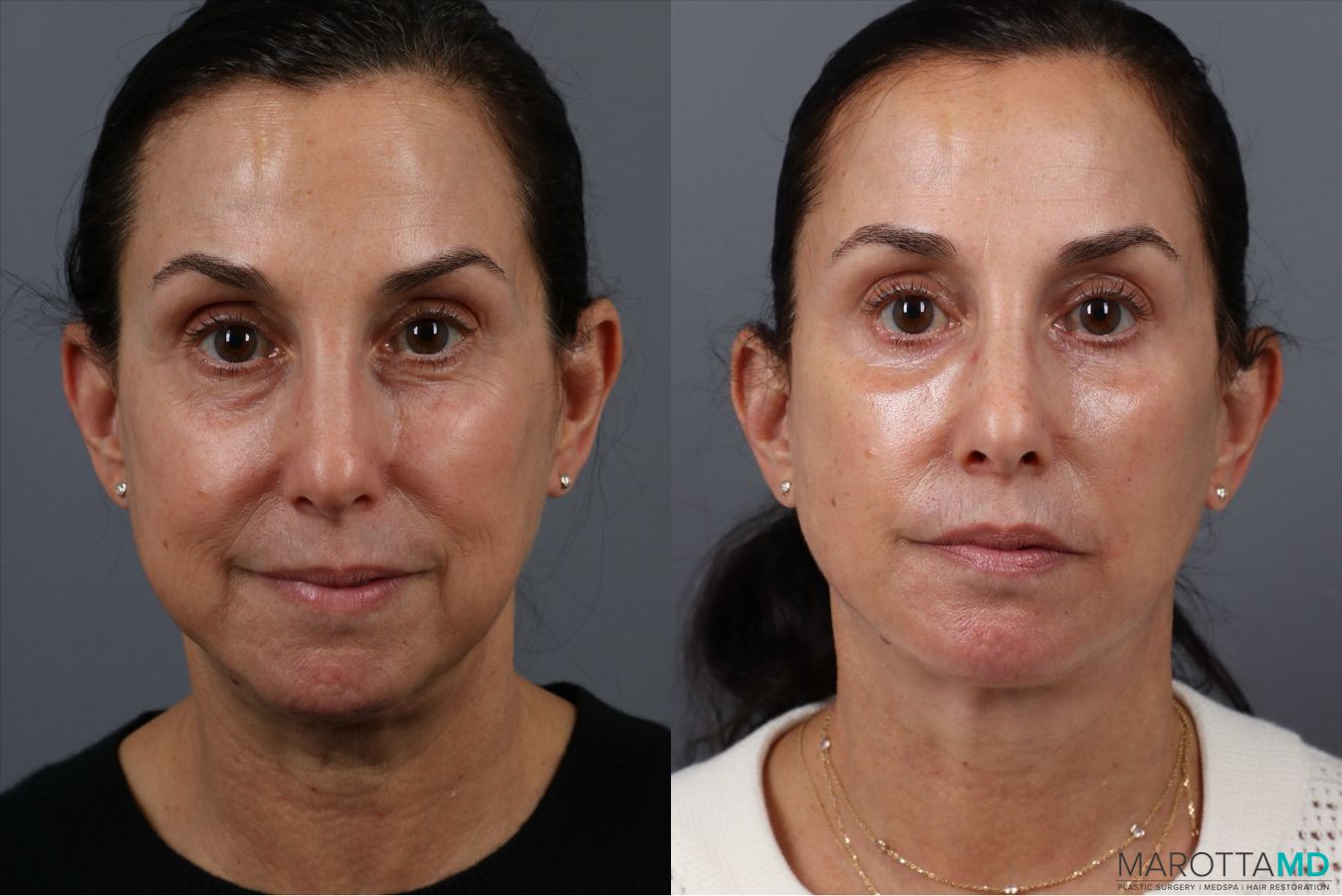 Before and after Fat Transfer - Face case 41866