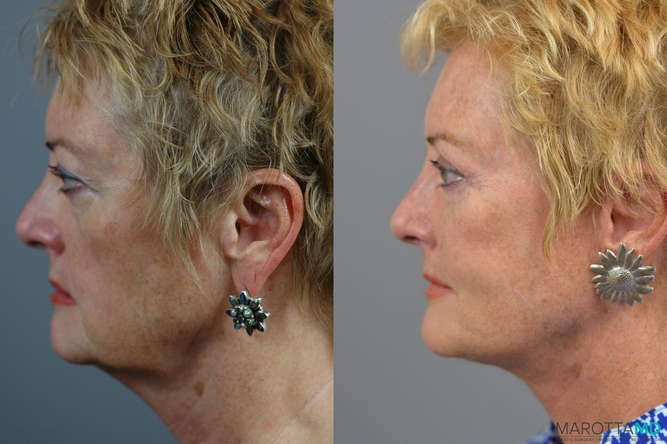Before and after Facelift & Neck Lift case 7005 - Angle 5