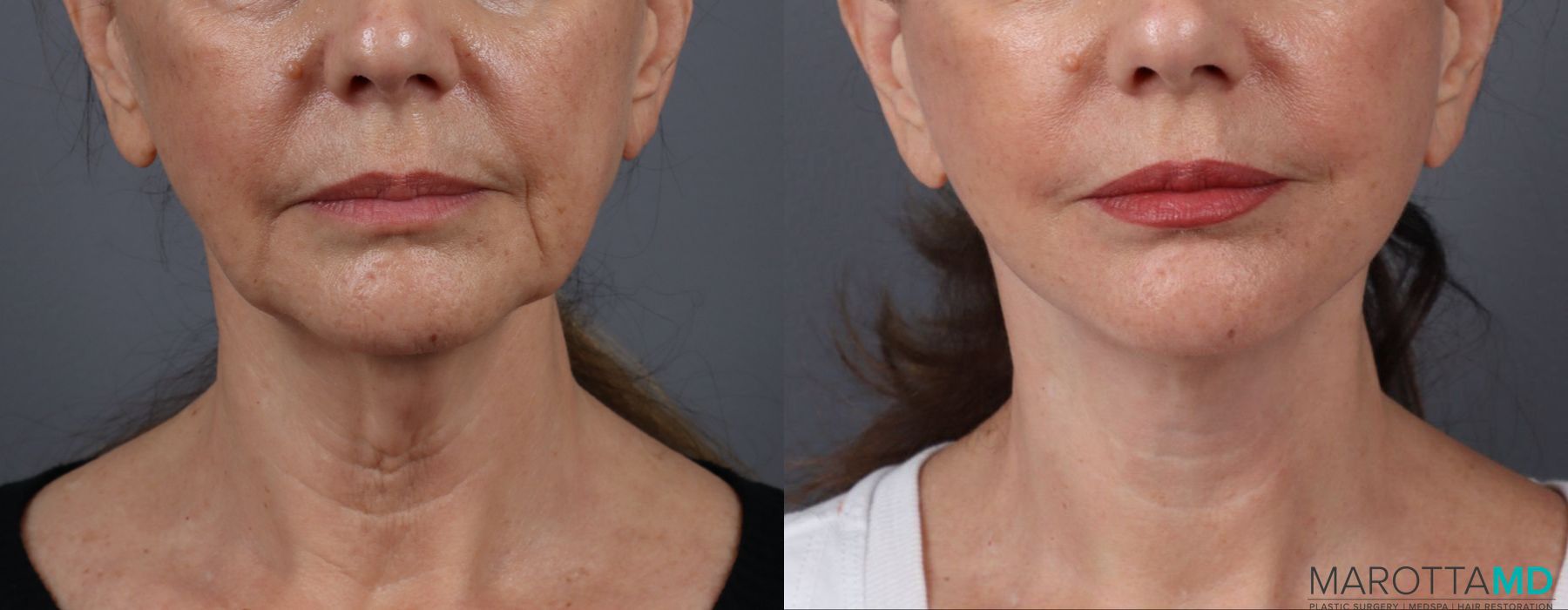 Facelift & Neck Lift - Case 205