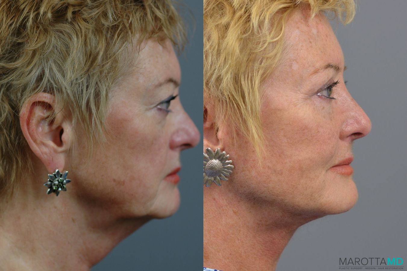 Before and after Facelift & Neck Lift case 7005 - Angle 4