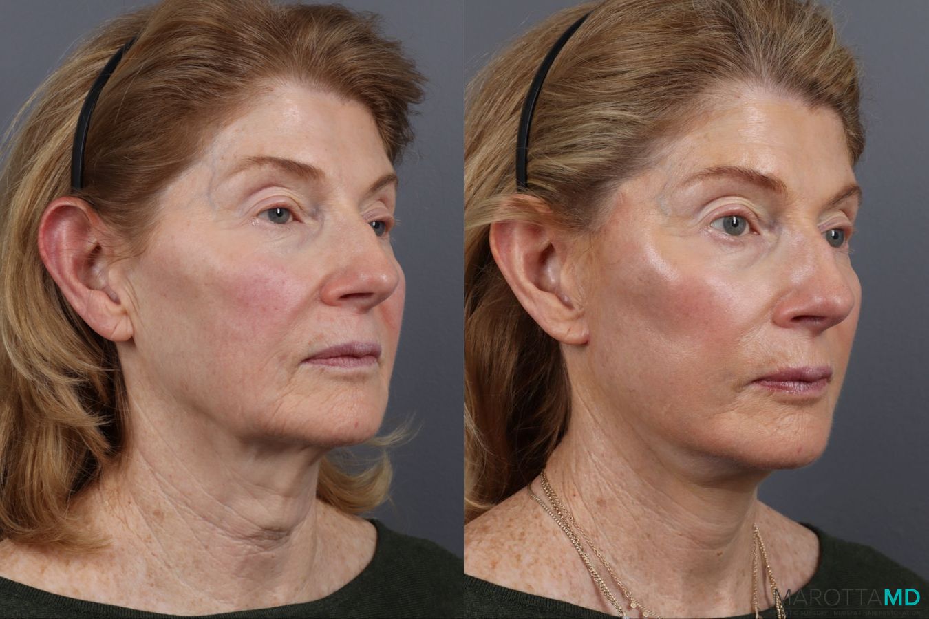 Before and after Facelift & Neck Lift case 12827 - Angle 2