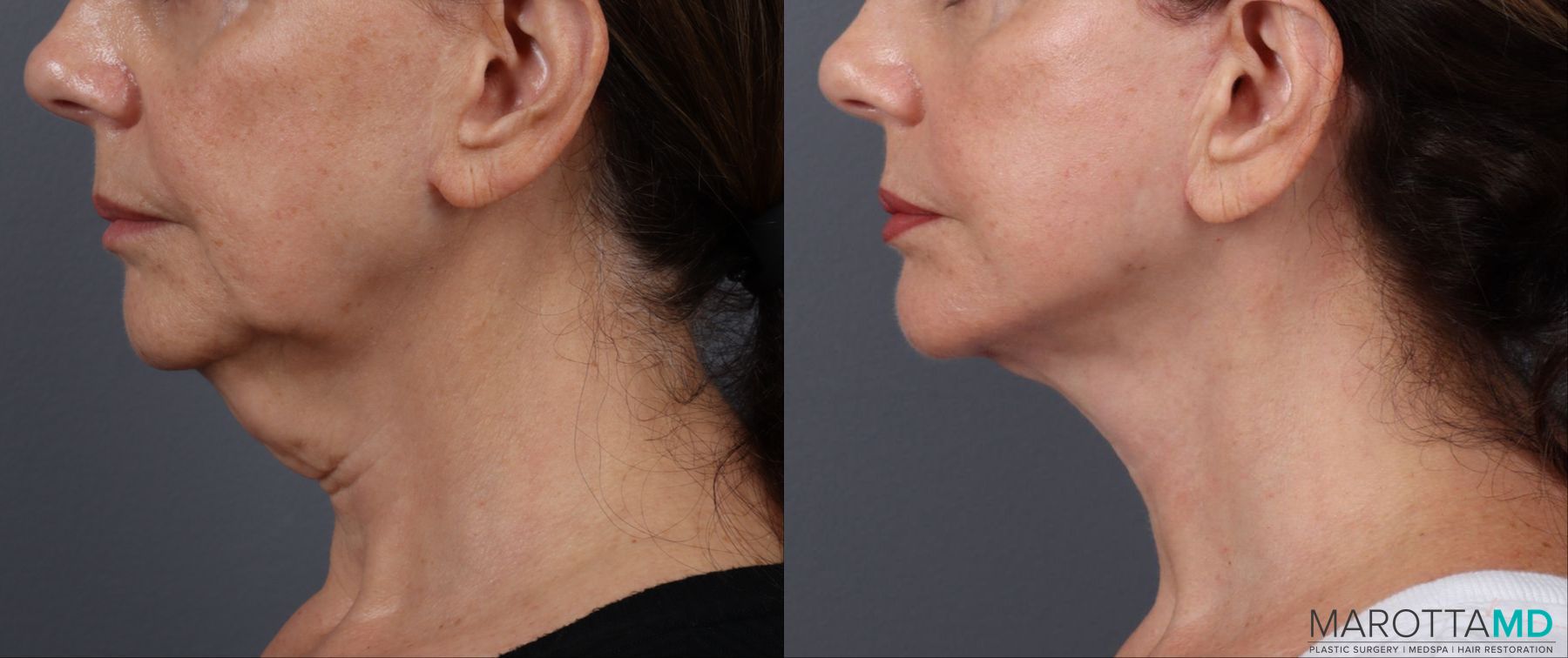 Before and after Facelift & Neck Lift case 19692 - Angle 5