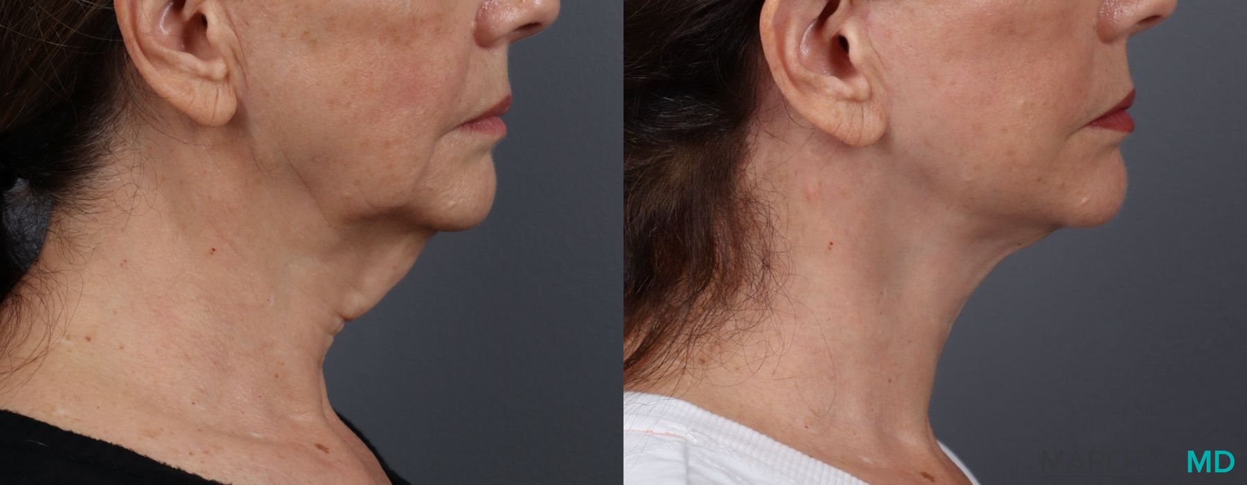 Facelift & Neck Lift - Thumbnail 3