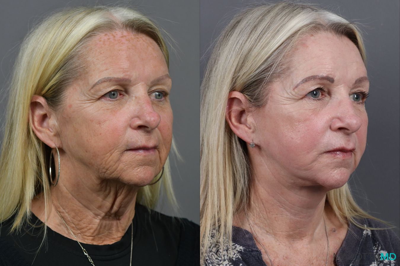 Before and after Facelift & Neck Lift case 17405 - Angle 2