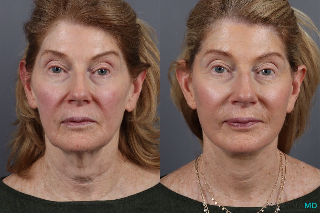 Before and after Facelift & Neck Lift case 12827