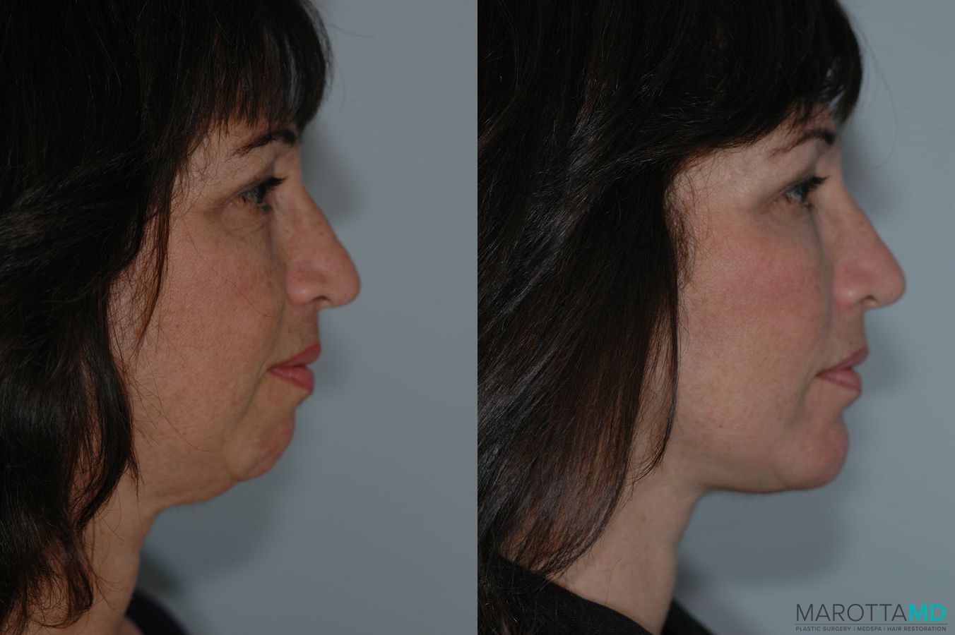 Before and after Facelift & Neck Lift case 7098 - Angle 3