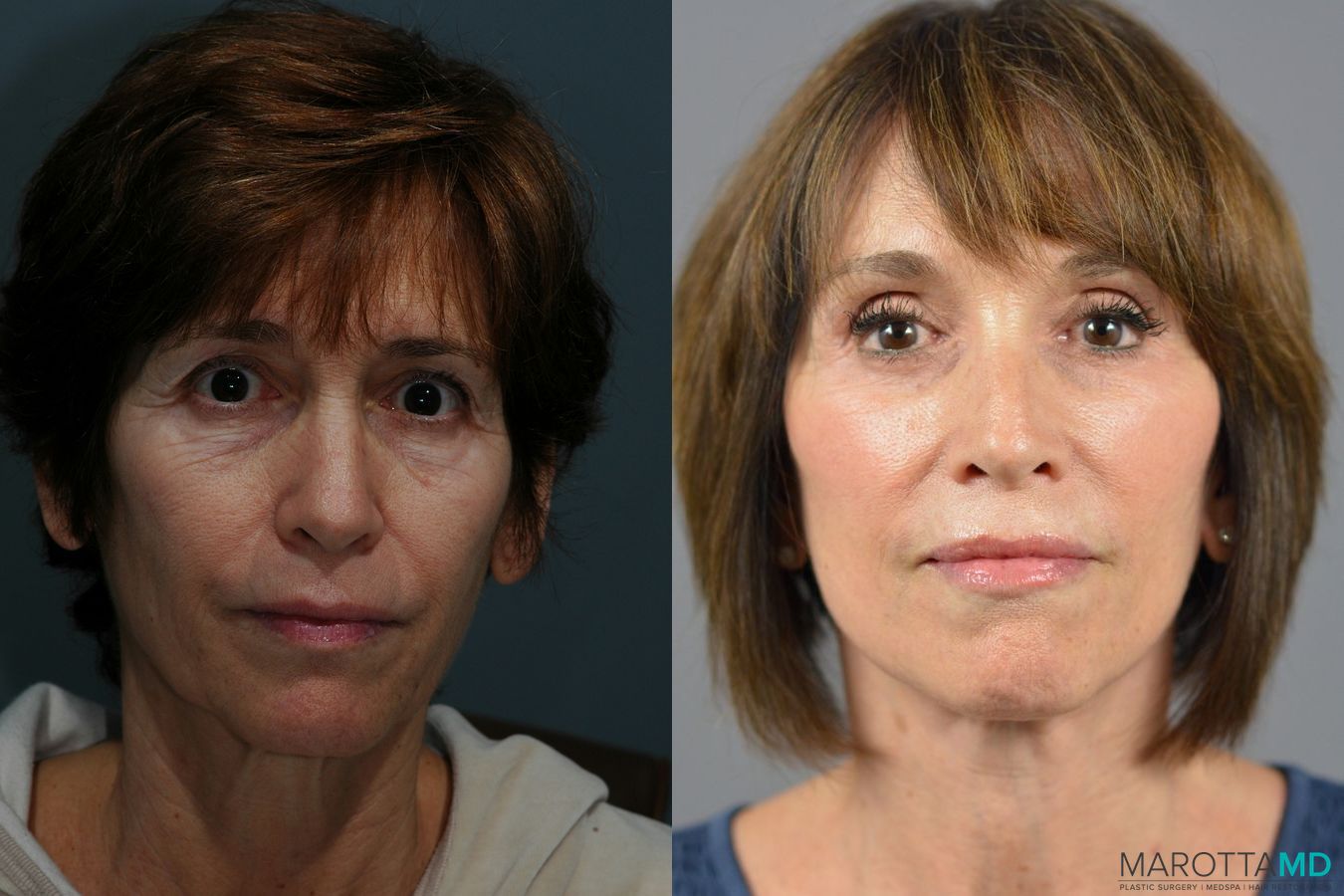 Before and after Facelift & Neck Lift case 6996