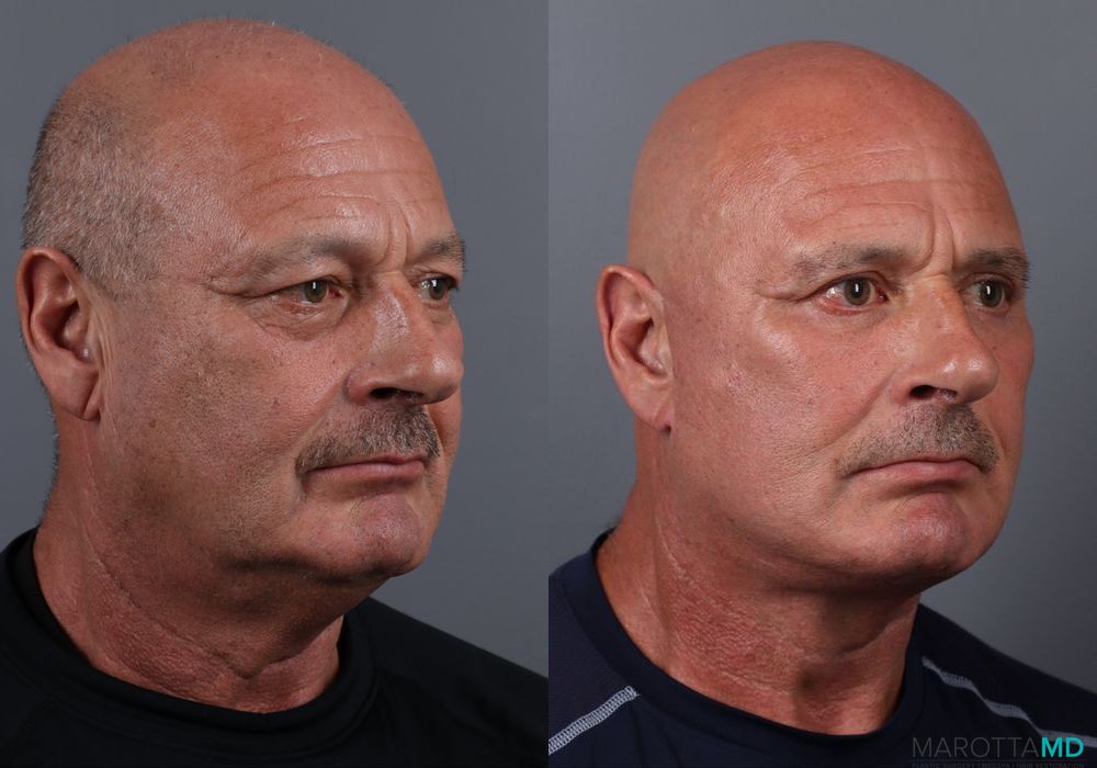 Blepharoplasty Lower - Thumbnail 2