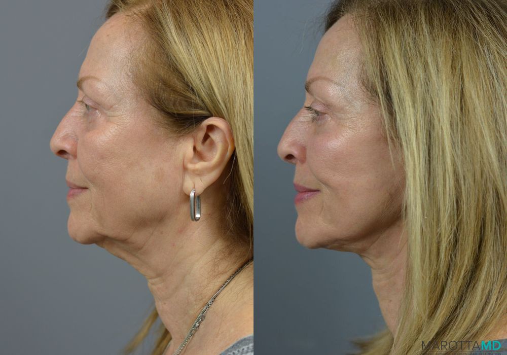 Facelift & Neck Lift - Thumbnail 3