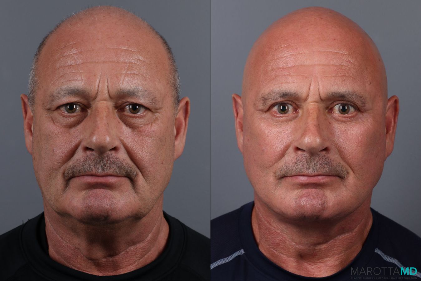 Before and after Blepharoplasty Upper case 19700