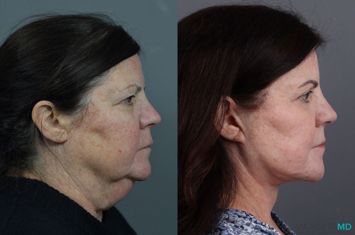 Before and after Facelift & Neck Lift case 7034 - Angle 3