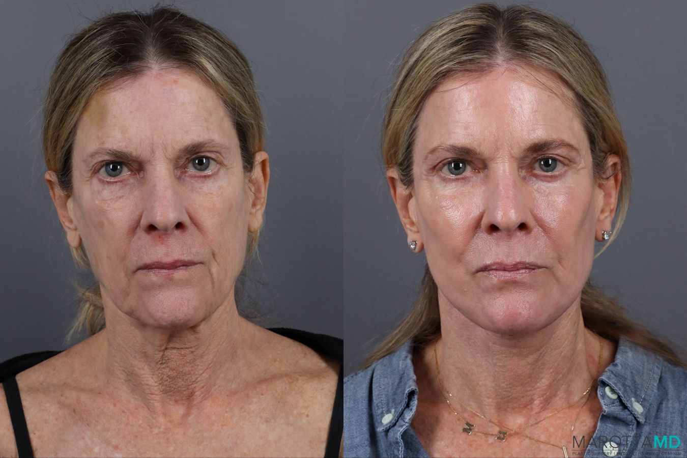 Before and after Blepharoplasty Lower case 19695