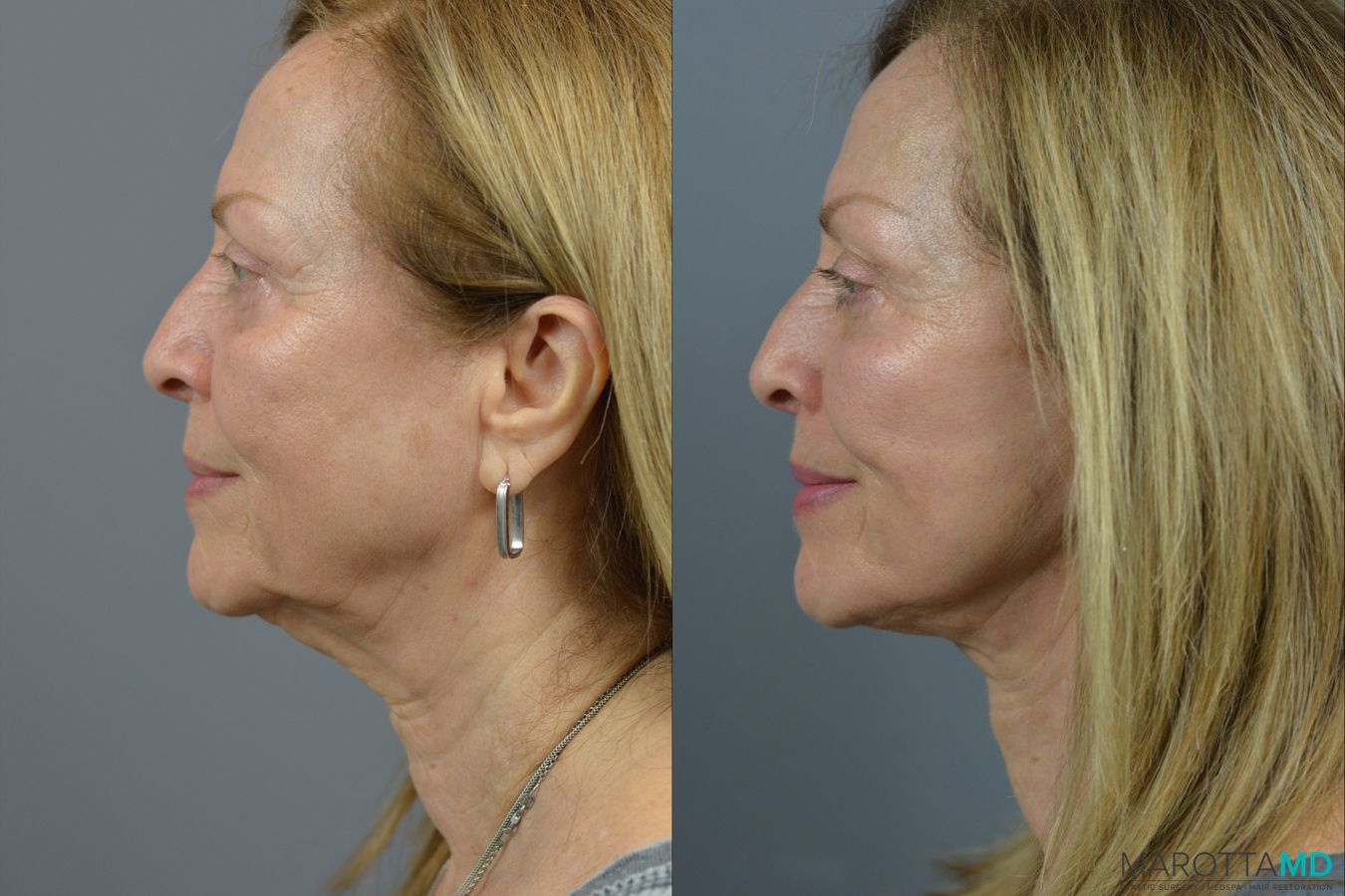 Before and after Facelift & Neck Lift case 21668 - Angle 3