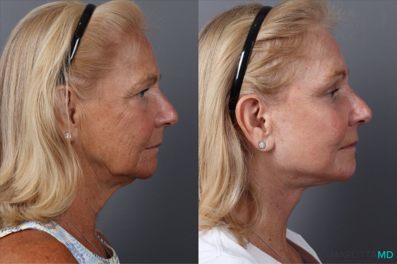 Before and after Laser Skin Resurfacing case 43233 - Angle 3