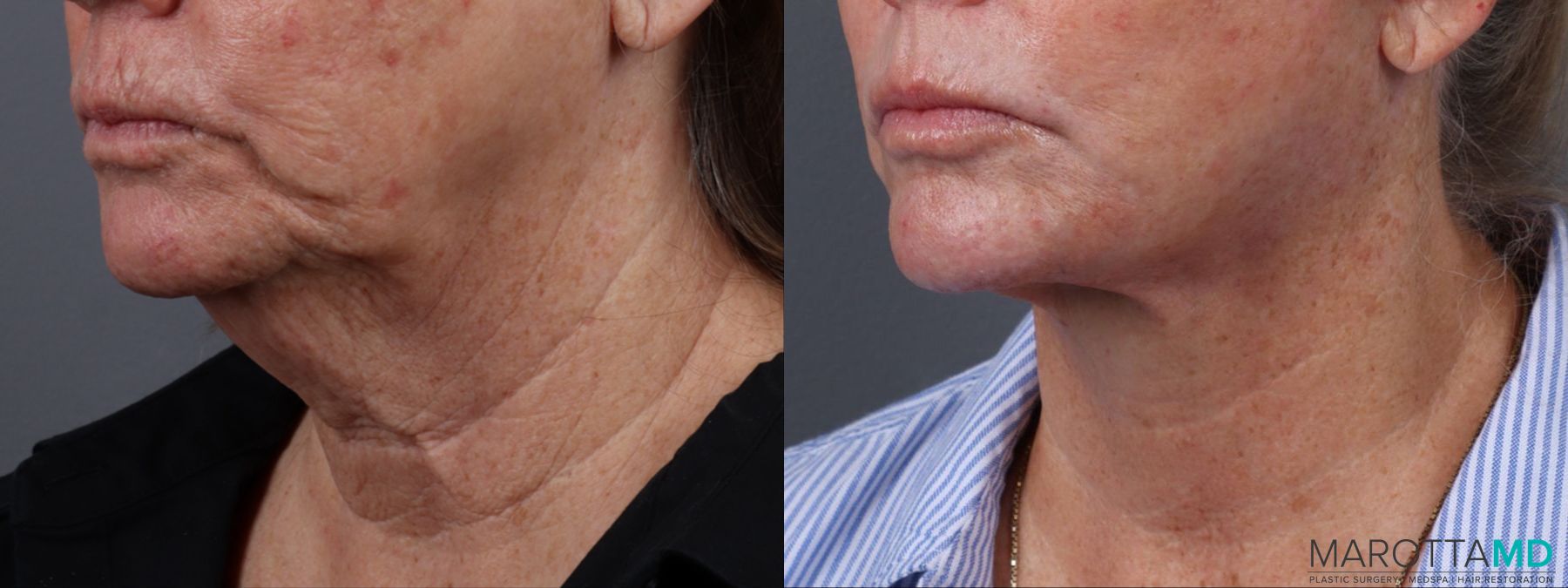 Before and after Fat Transfer - Face case 23768 - Angle 4