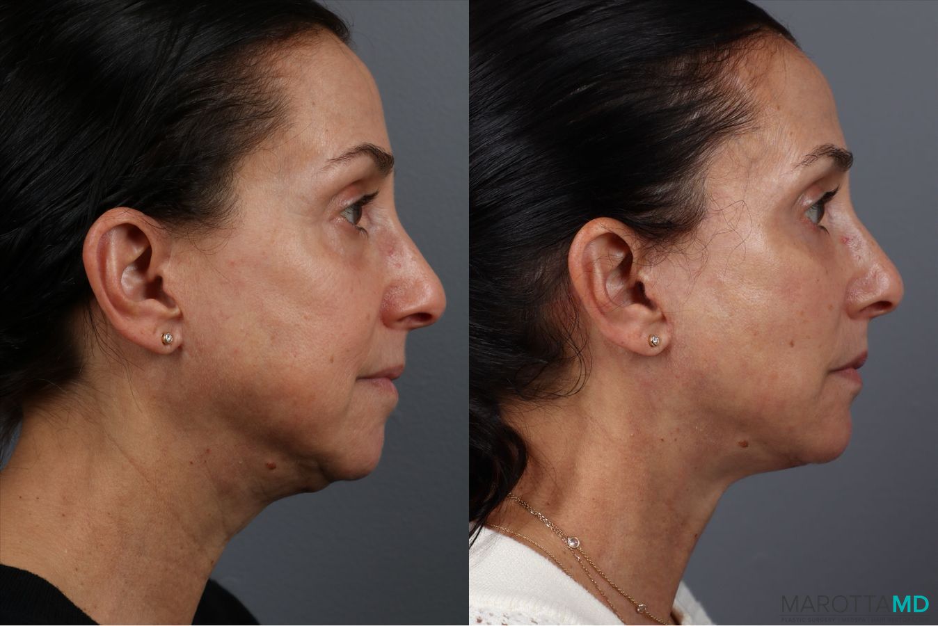 Before and after Fat Transfer - Face case 41866 - Angle 3
