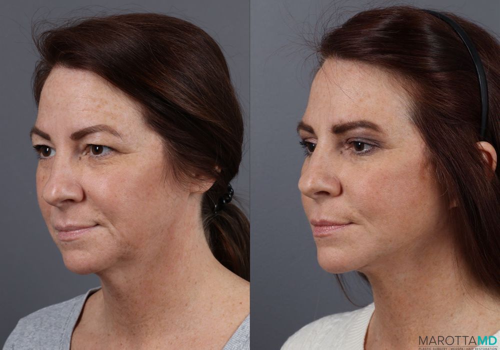 Before and after Facelift & Neck Lift case 12316 - Angle 4