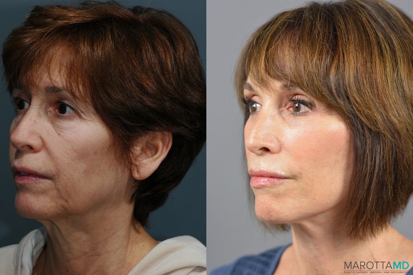 Before and after Facelift & Neck Lift case 6996 - Angle 4