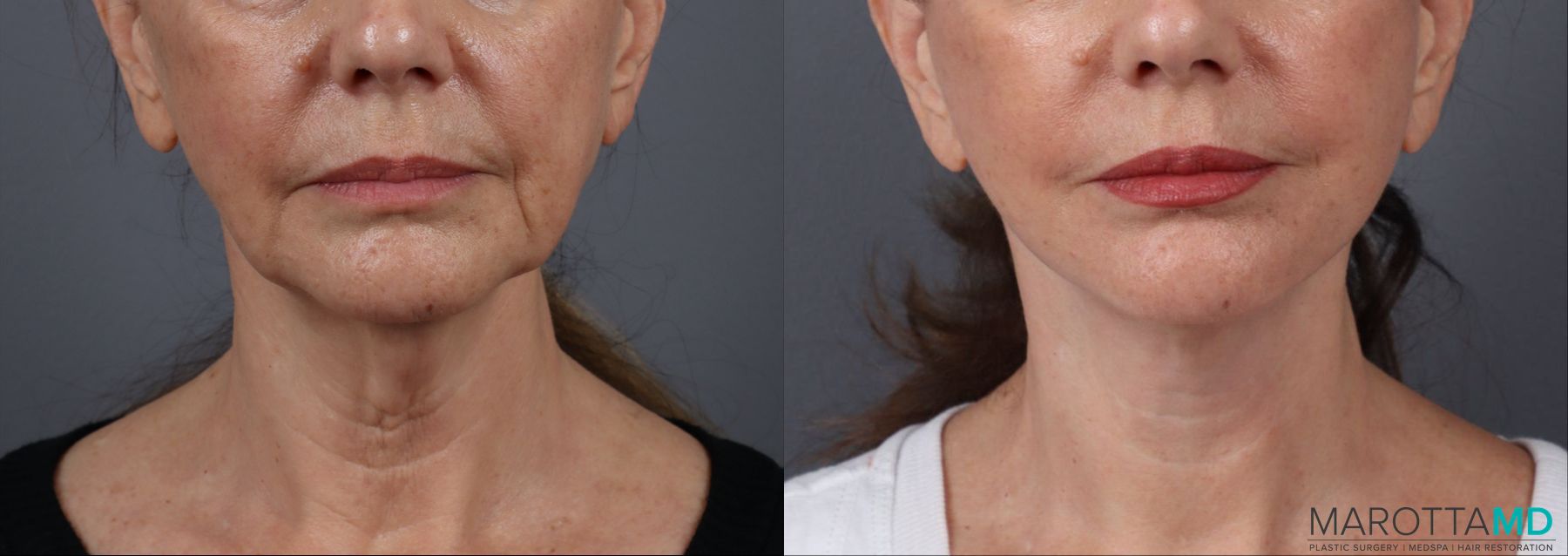 Before and after Facelift & Neck Lift case 19692