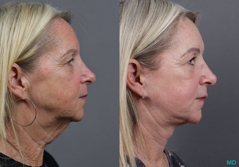 Facelift & Neck Lift - Thumbnail 3