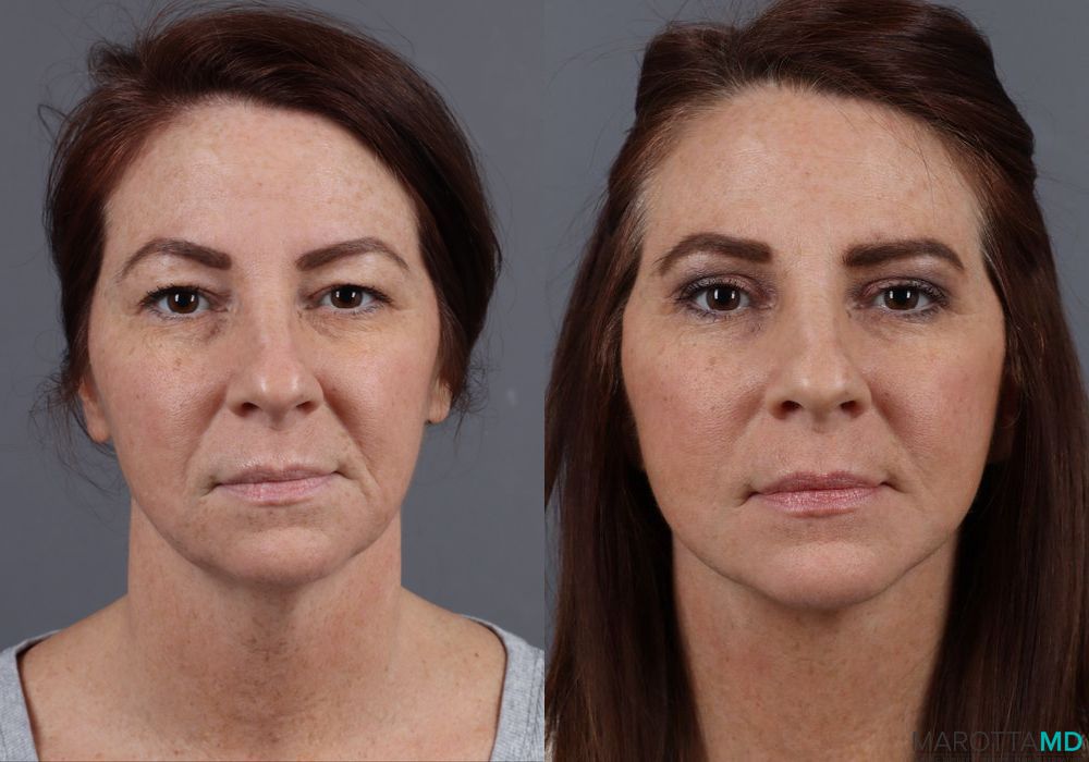 Before and after Facelift & Neck Lift case 12316