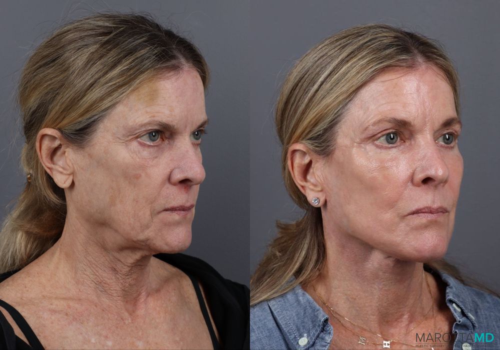 Fat Transfer - Face - Thumbnail 2