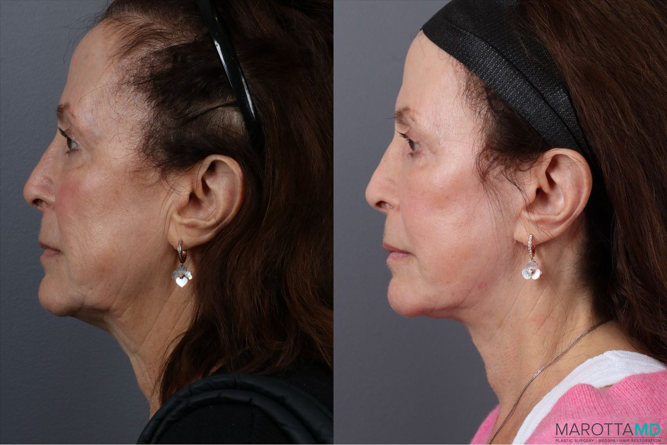 Before and after Laser Skin Resurfacing case 41861 - Angle 5