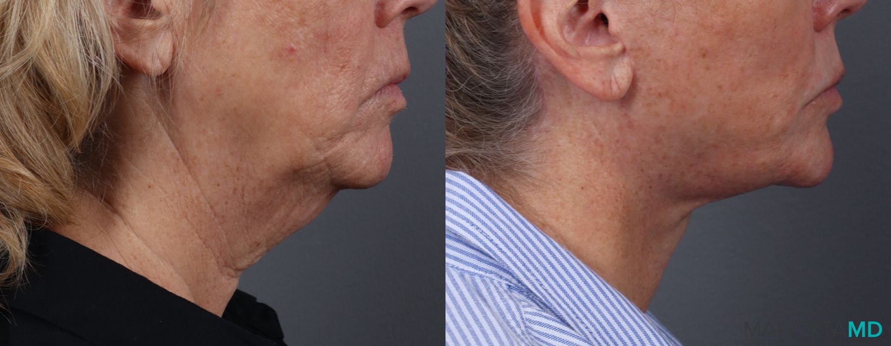 Facelift & Neck Lift - Thumbnail 3