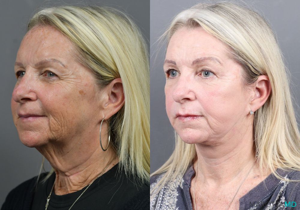 Facelift & Neck Lift - Thumbnail 4