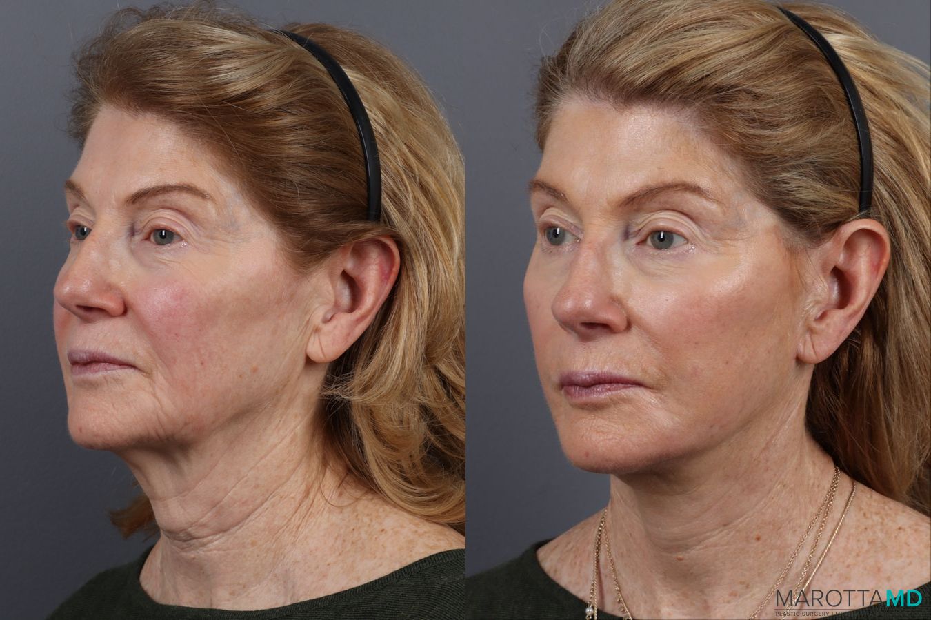 Before and after Facelift & Neck Lift case 12827 - Angle 4