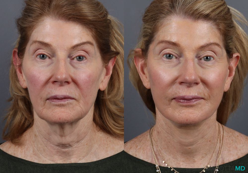 Facelift & Neck Lift - Case 1003