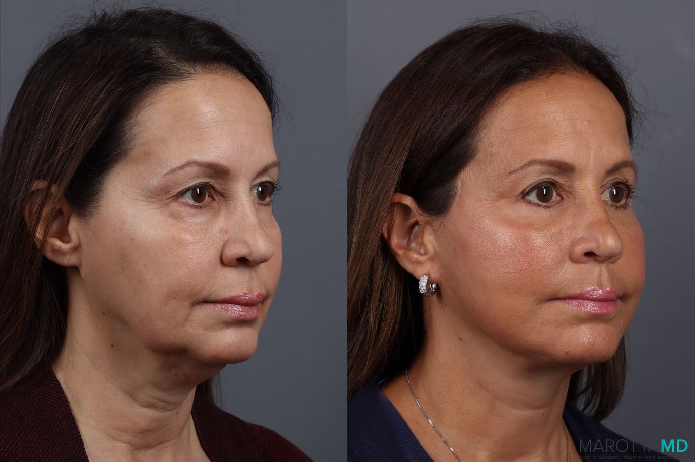 Before and after Facelift & Neck Lift case 7092 - Angle 2