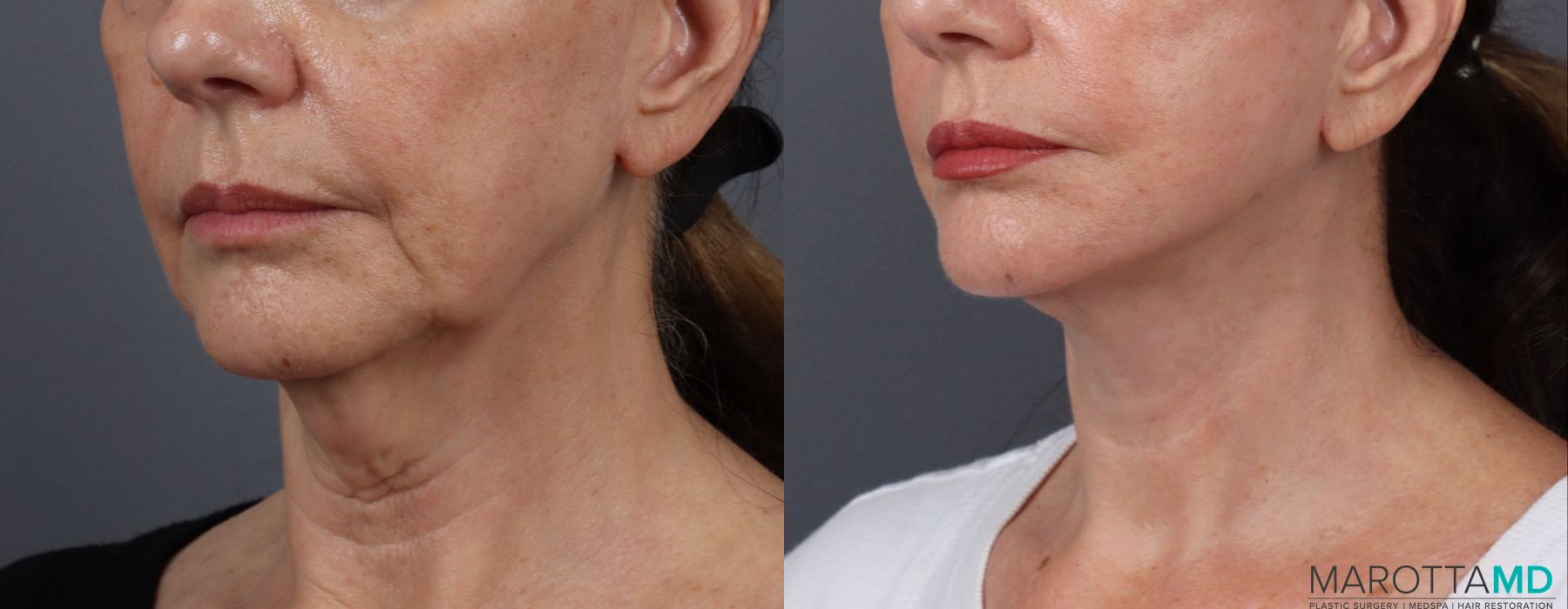 Facelift & Neck Lift - Thumbnail 4