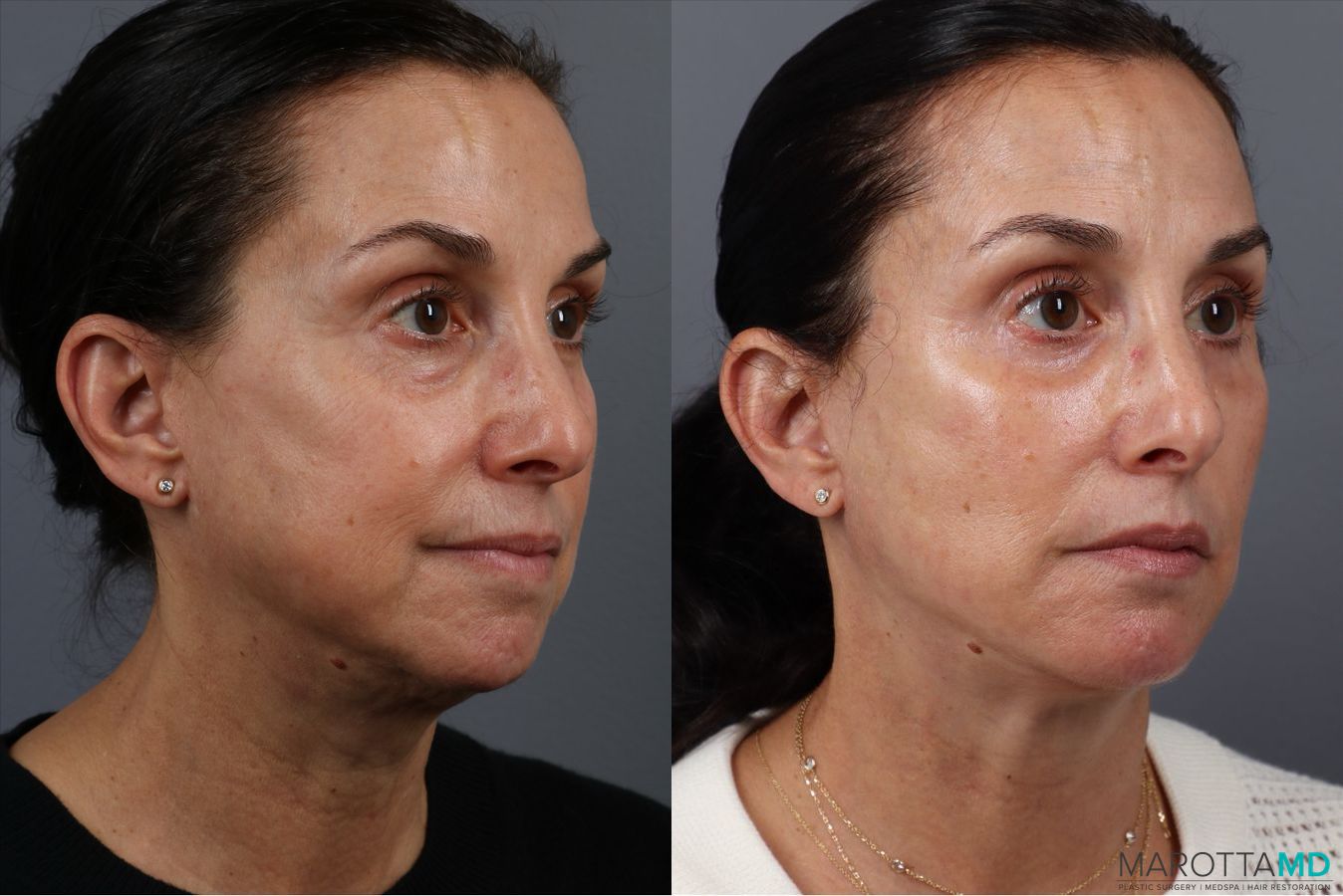 Before and after Fat Transfer - Face case 41866 - Angle 2