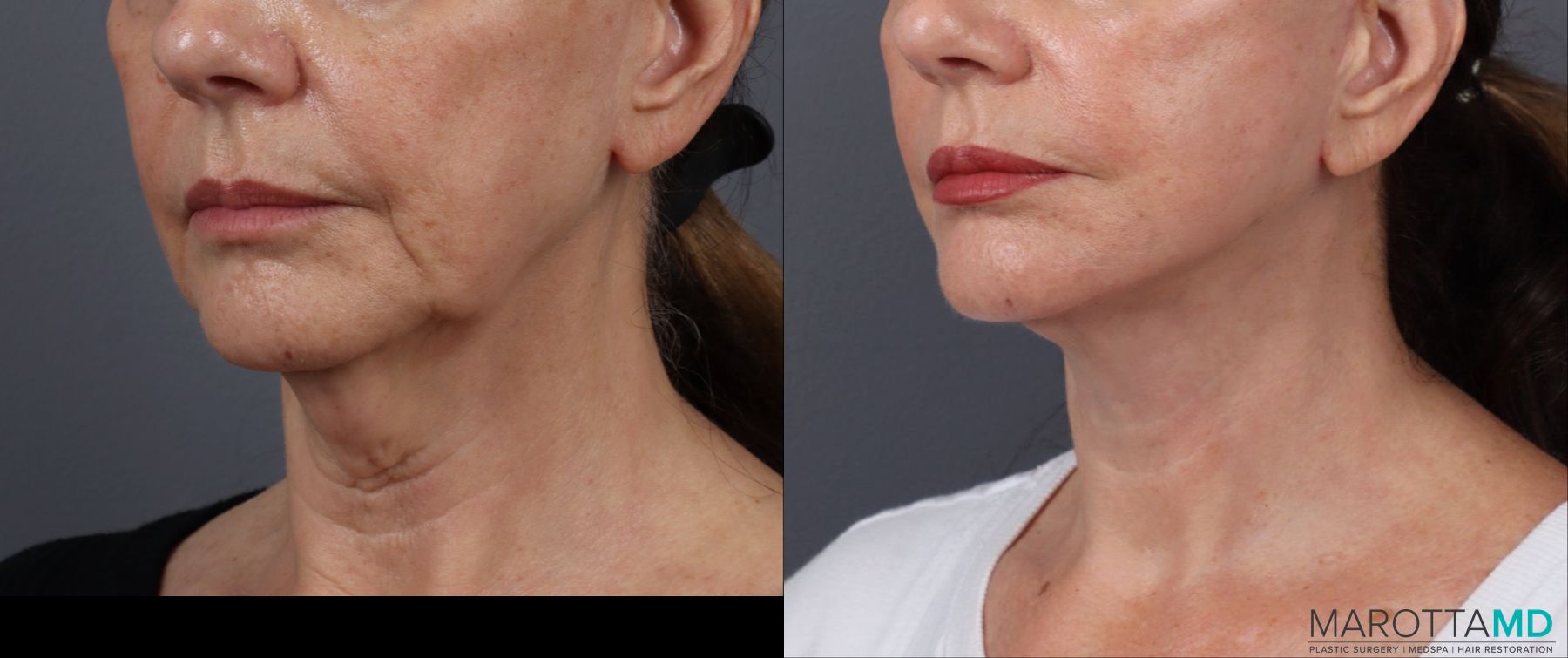 Before and after Facelift & Neck Lift case 19692 - Angle 4