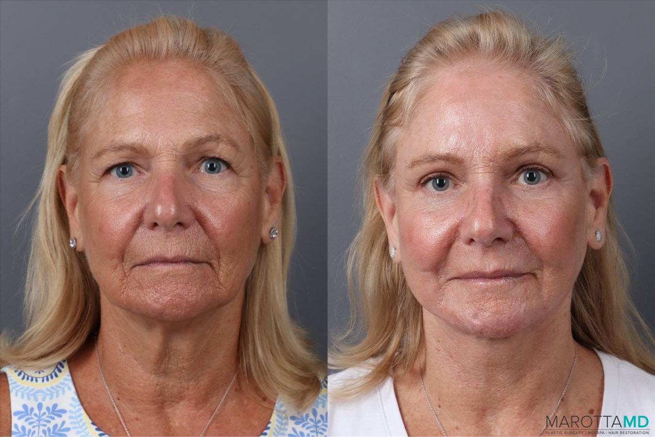 Before and after Laser Skin Resurfacing case 43233
