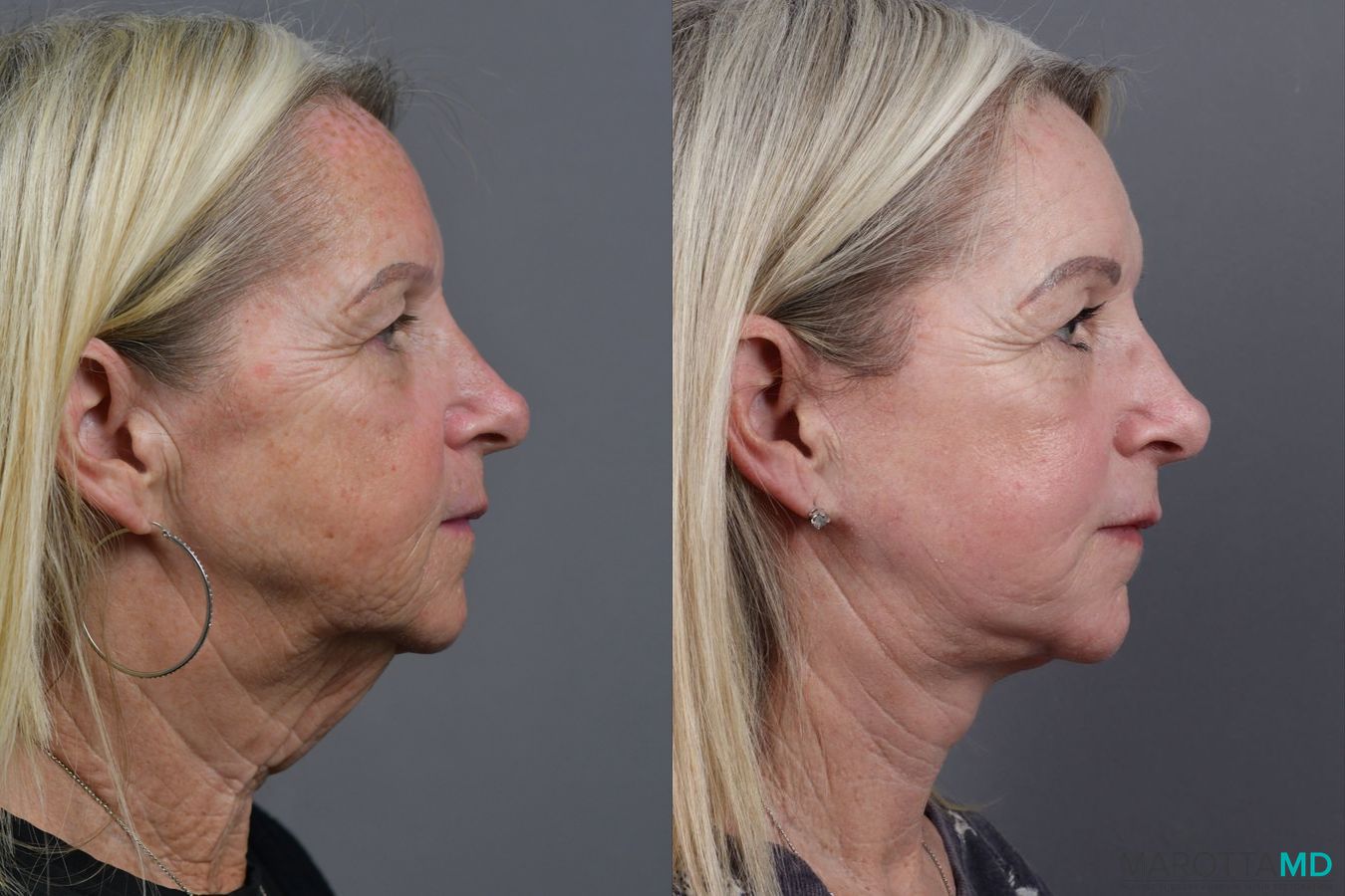 Before and after Facelift & Neck Lift case 17405 - Angle 3