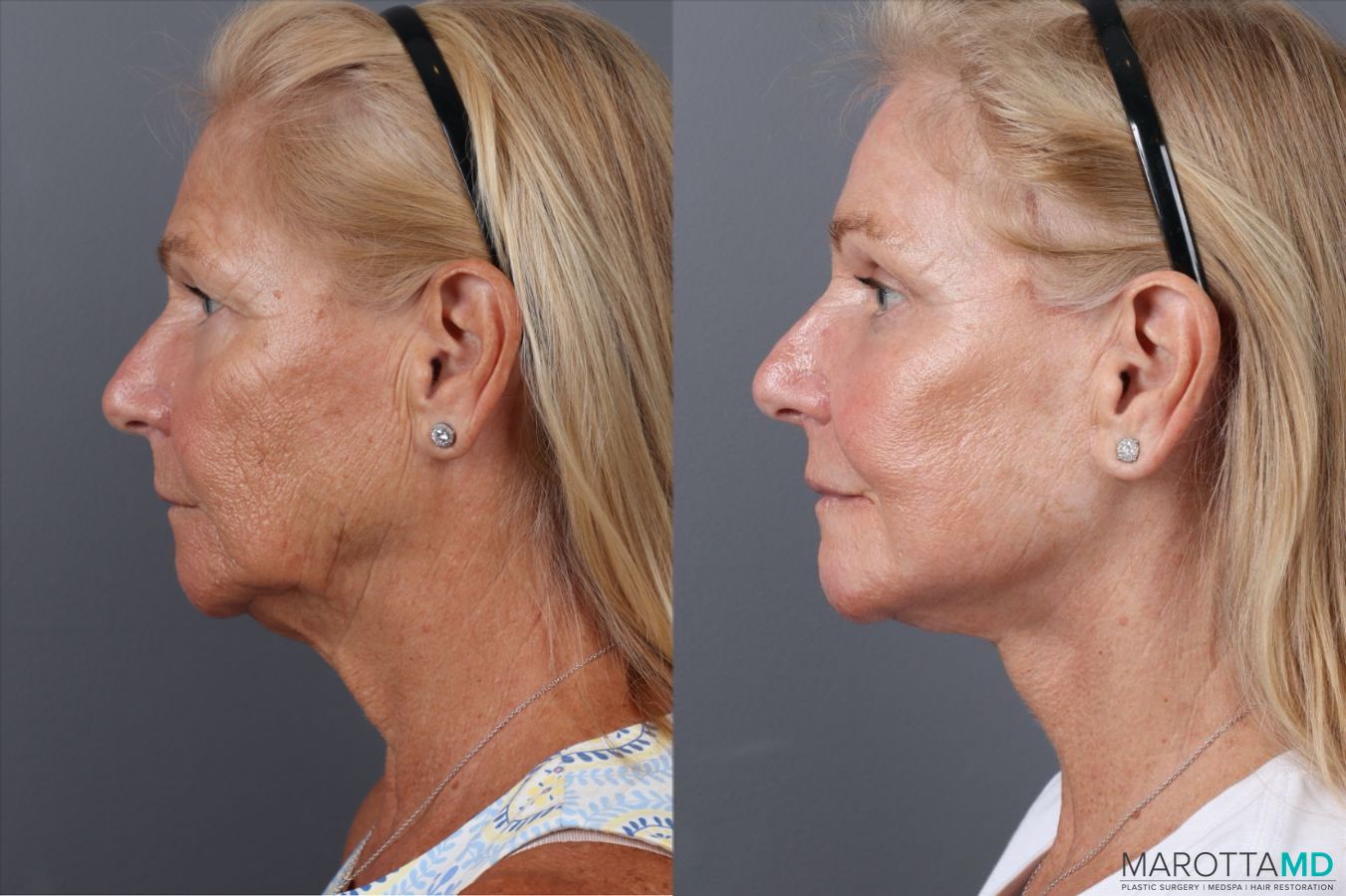 Before and after Laser Skin Resurfacing case 43233 - Angle 5