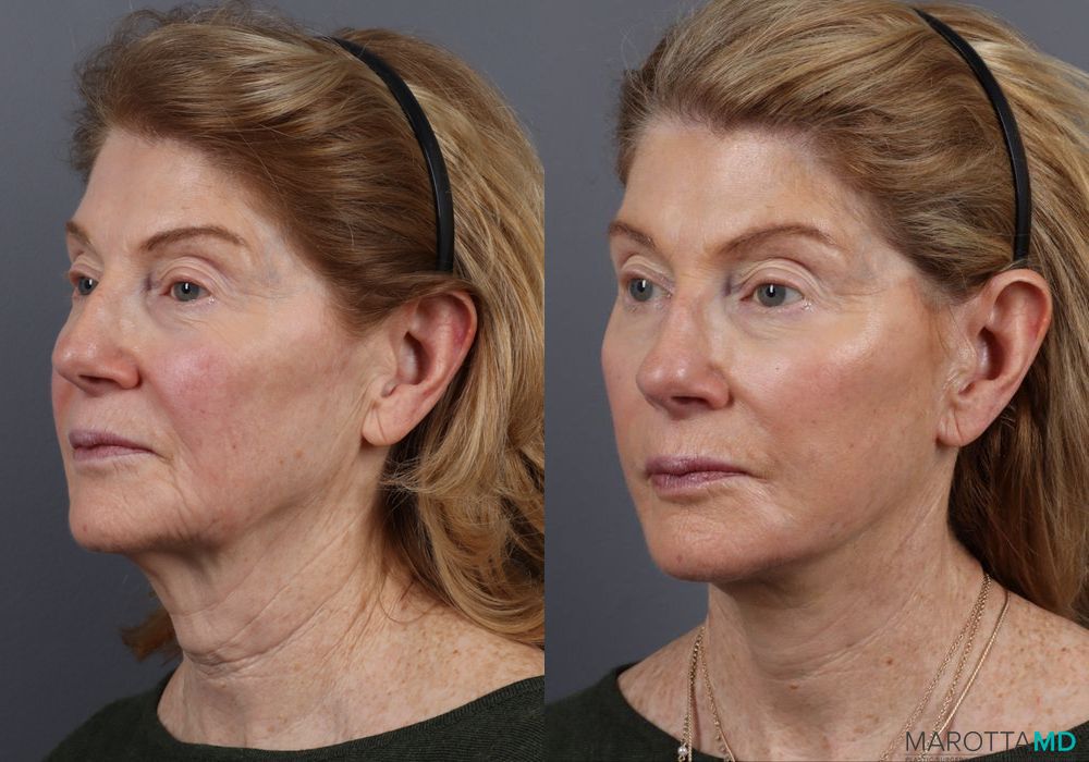 Facelift & Neck Lift - Thumbnail 4