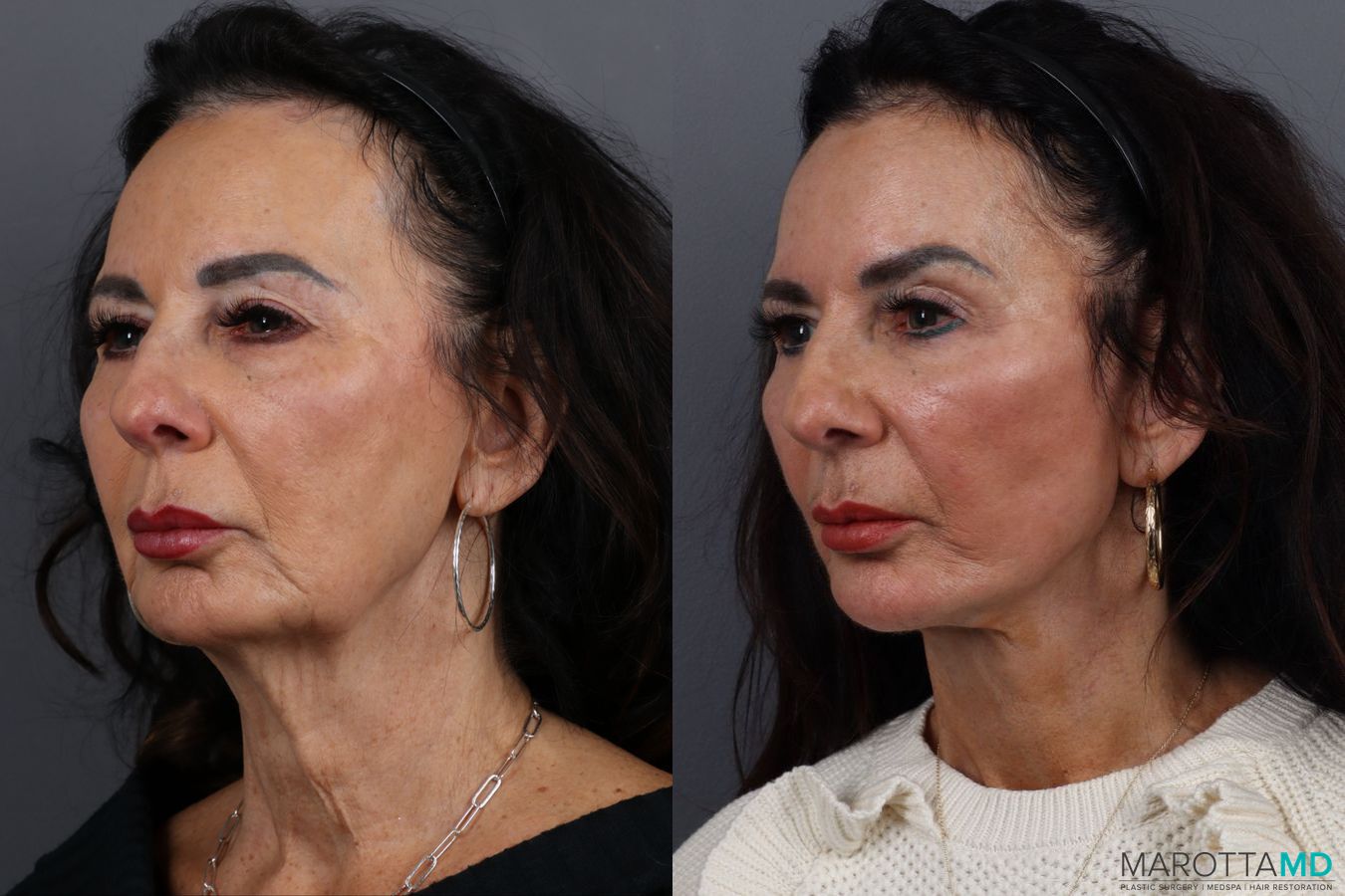 Before and after Facelift & Neck Lift case 12922 - Angle 4