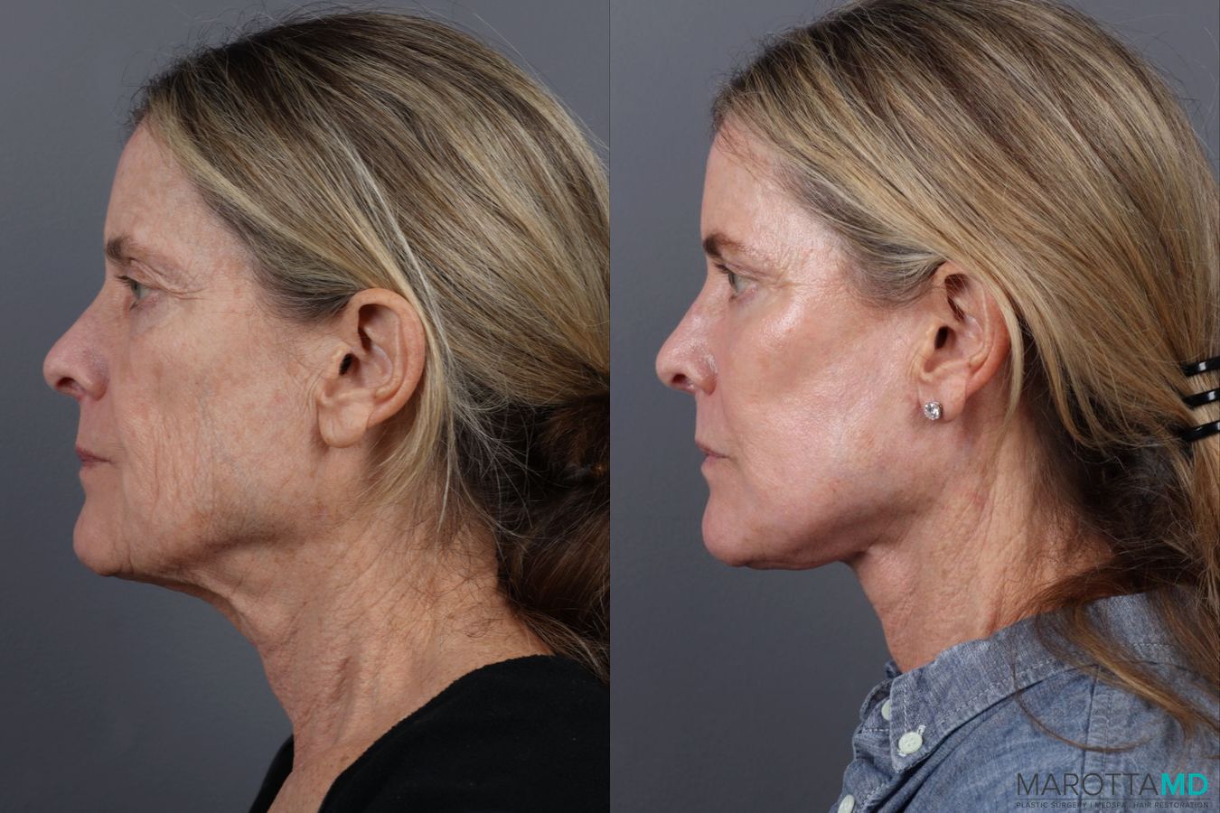 Before and after Blepharoplasty Lower case 19695 - Angle 5