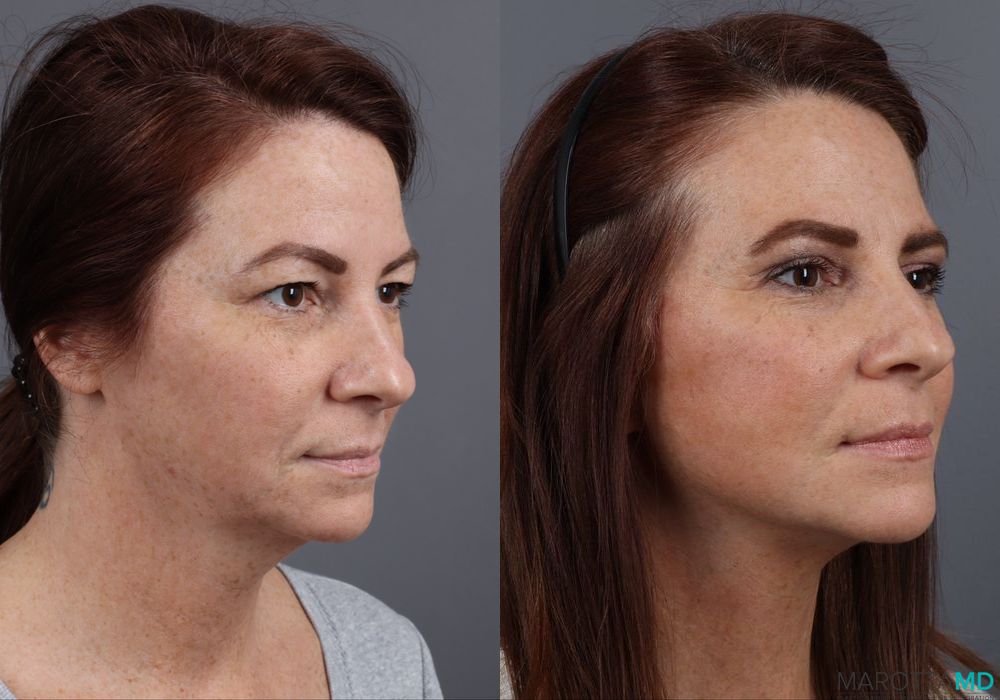 Before and after Facelift & Neck Lift case 12316 - Angle 2