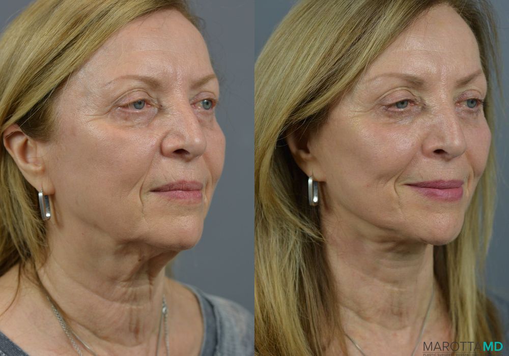 Facelift & Neck Lift - Thumbnail 5