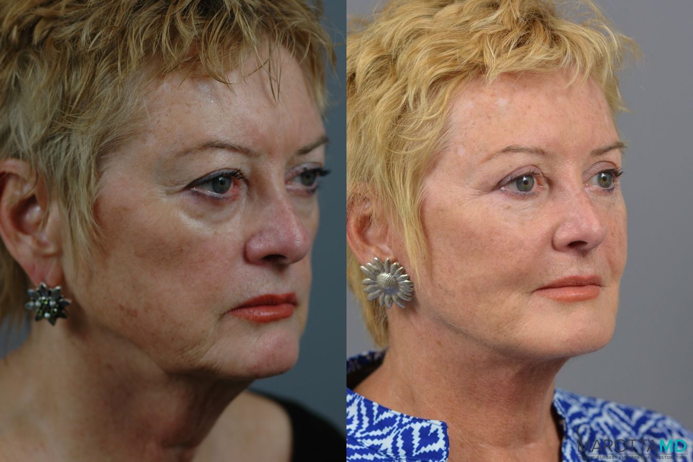 Before and after Facelift & Neck Lift case 7005 - Angle 3