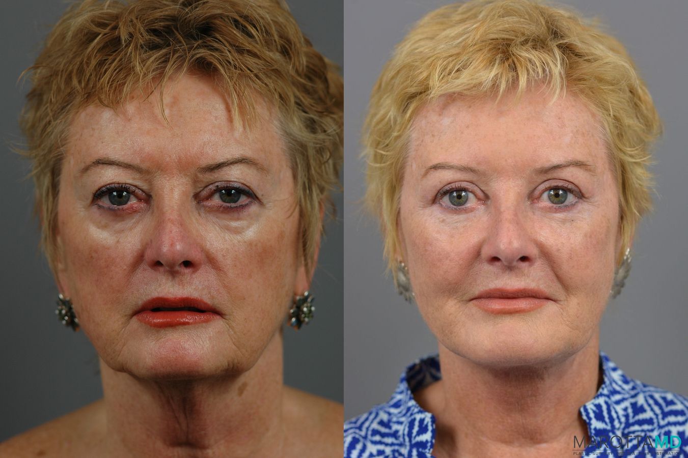 Before and after Facelift & Neck Lift case 7005