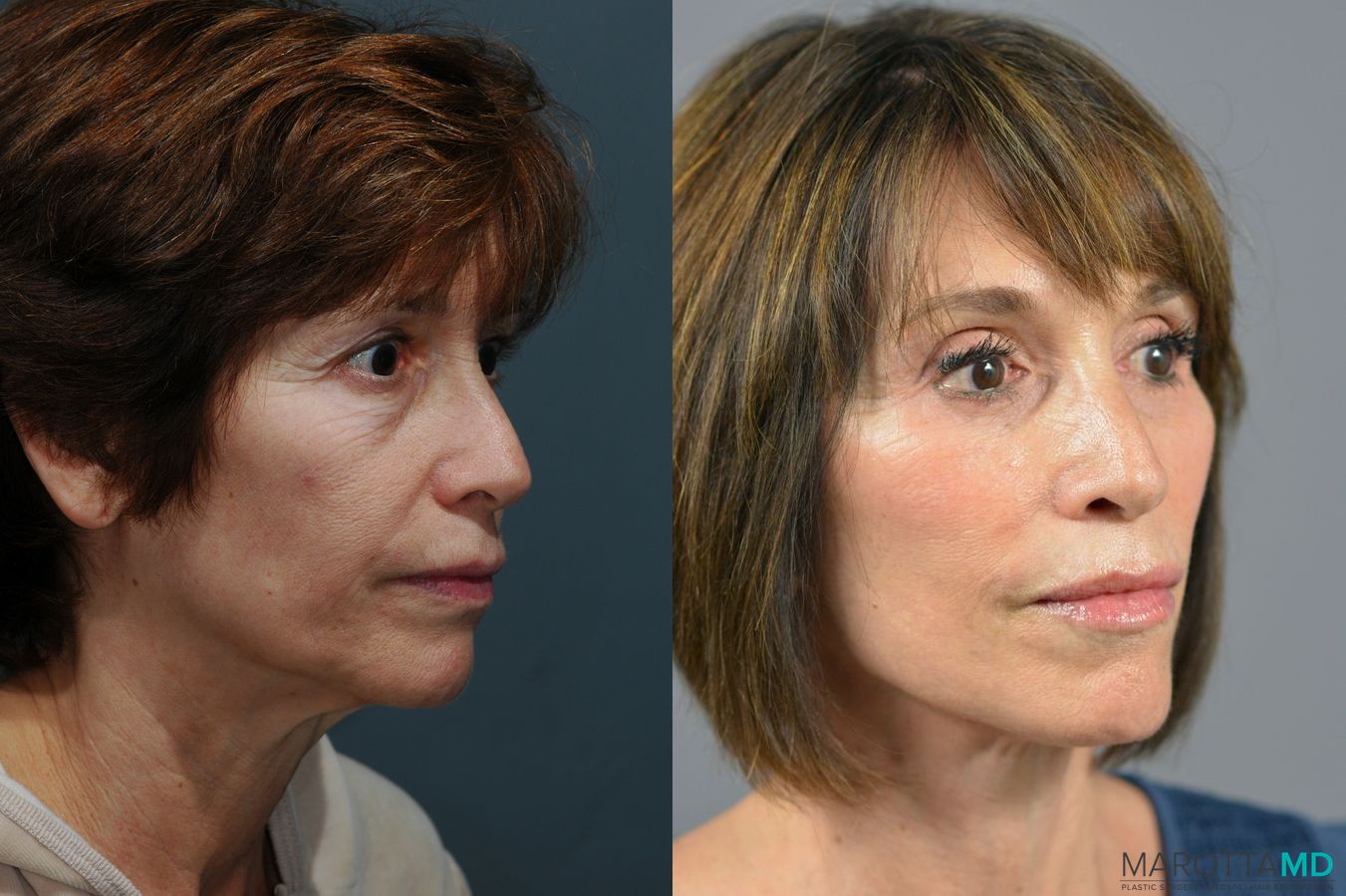 Before and after Facelift & Neck Lift case 6996 - Angle 3