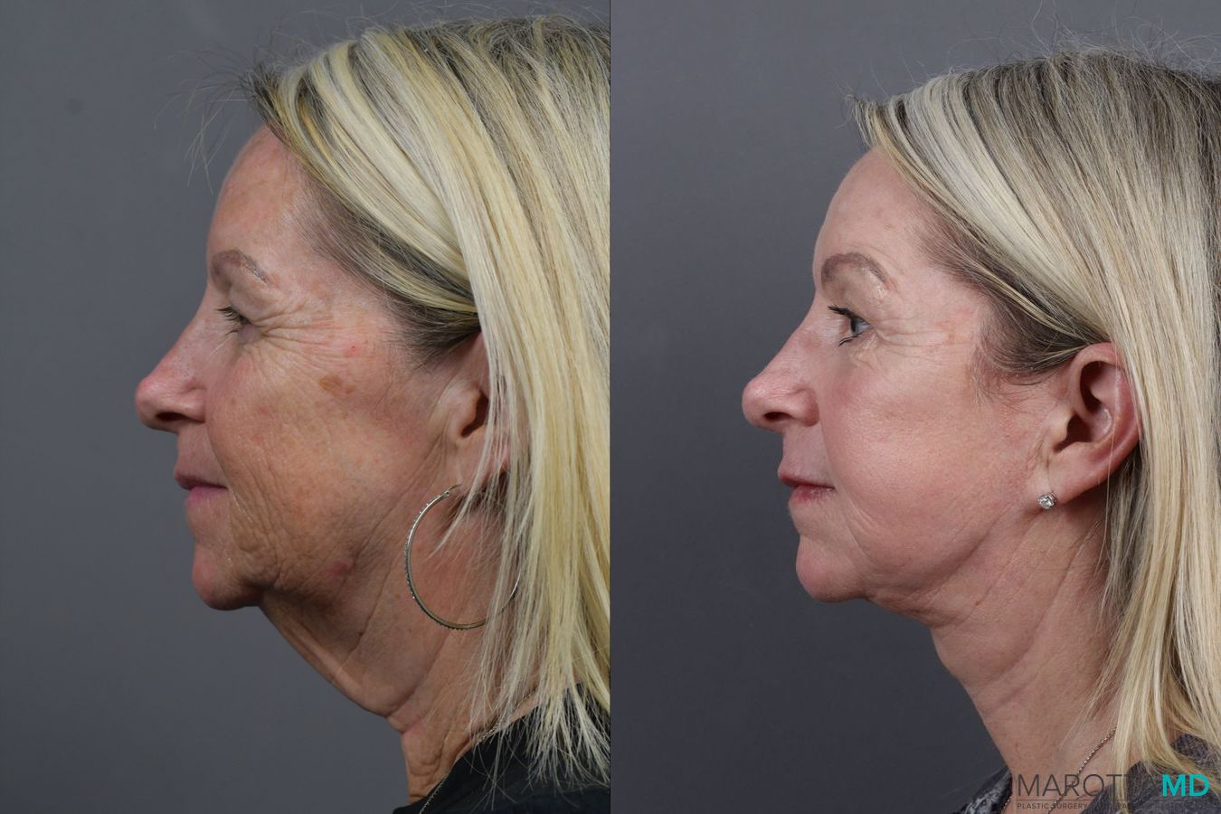 Before and after Facelift & Neck Lift case 17405 - Angle 5