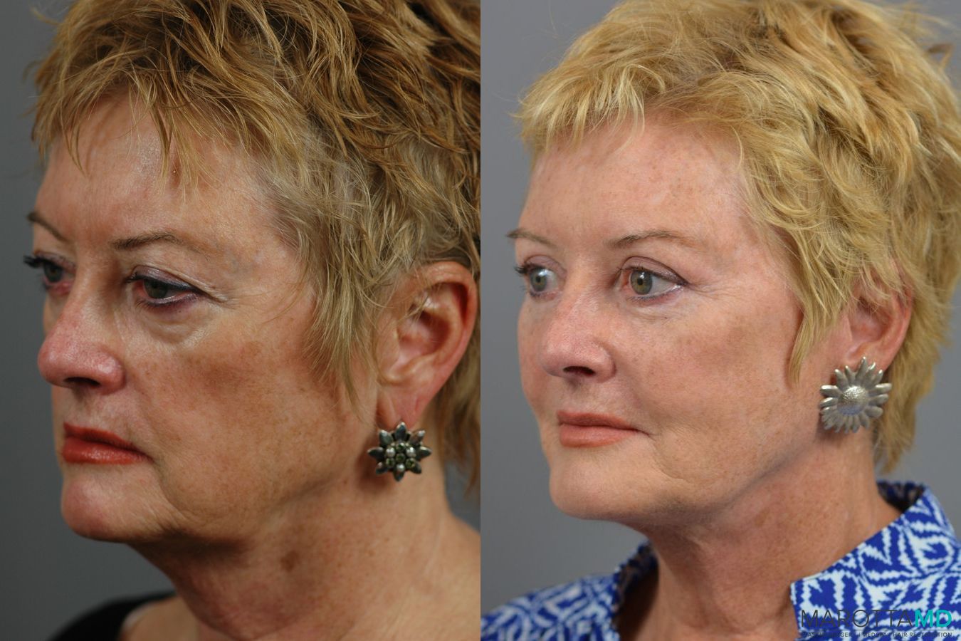 Before and after Facelift & Neck Lift case 7005 - Angle 2