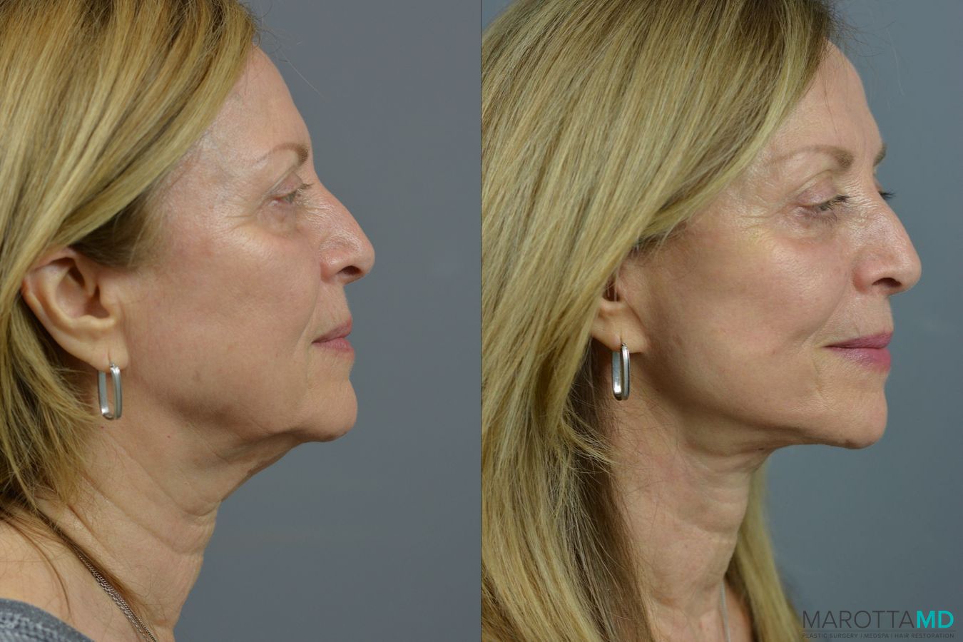 Before and after Facelift & Neck Lift case 21668 - Angle 4
