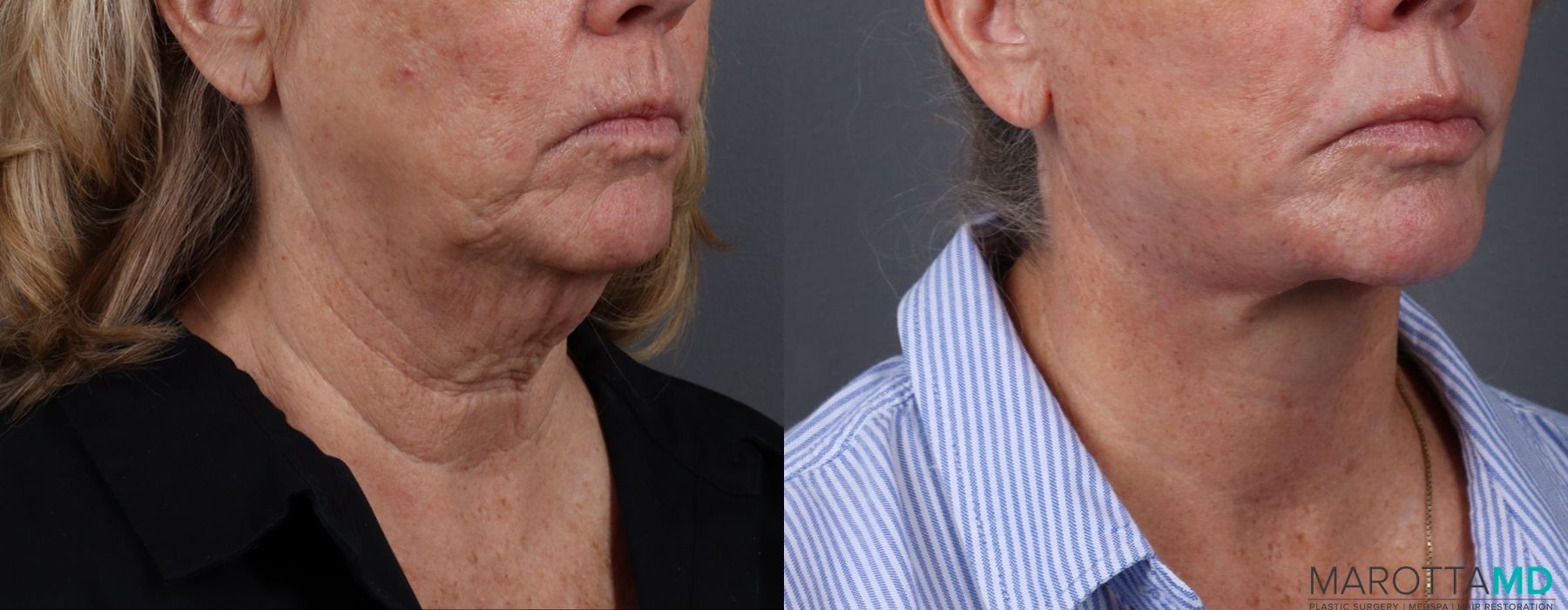 Facelift & Neck Lift - Thumbnail 2